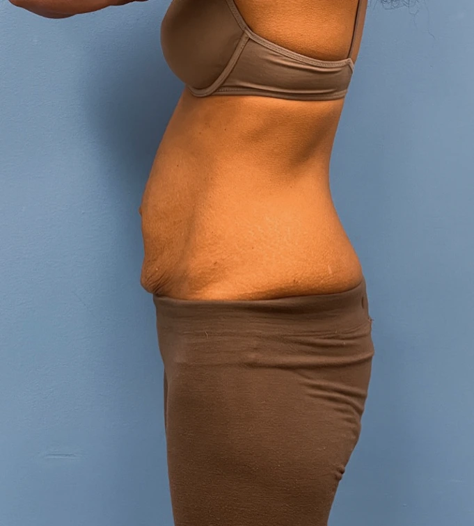 Abdominoplasty-Case--24922 | Before Dr. Samir Rao 2