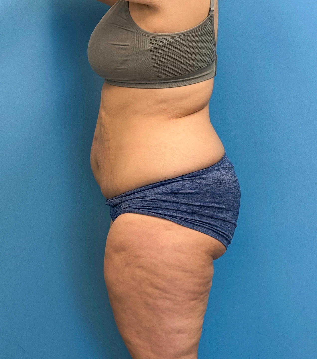 Tummy-Tuck-Case--28426 | Before Tummy Tuck 2
