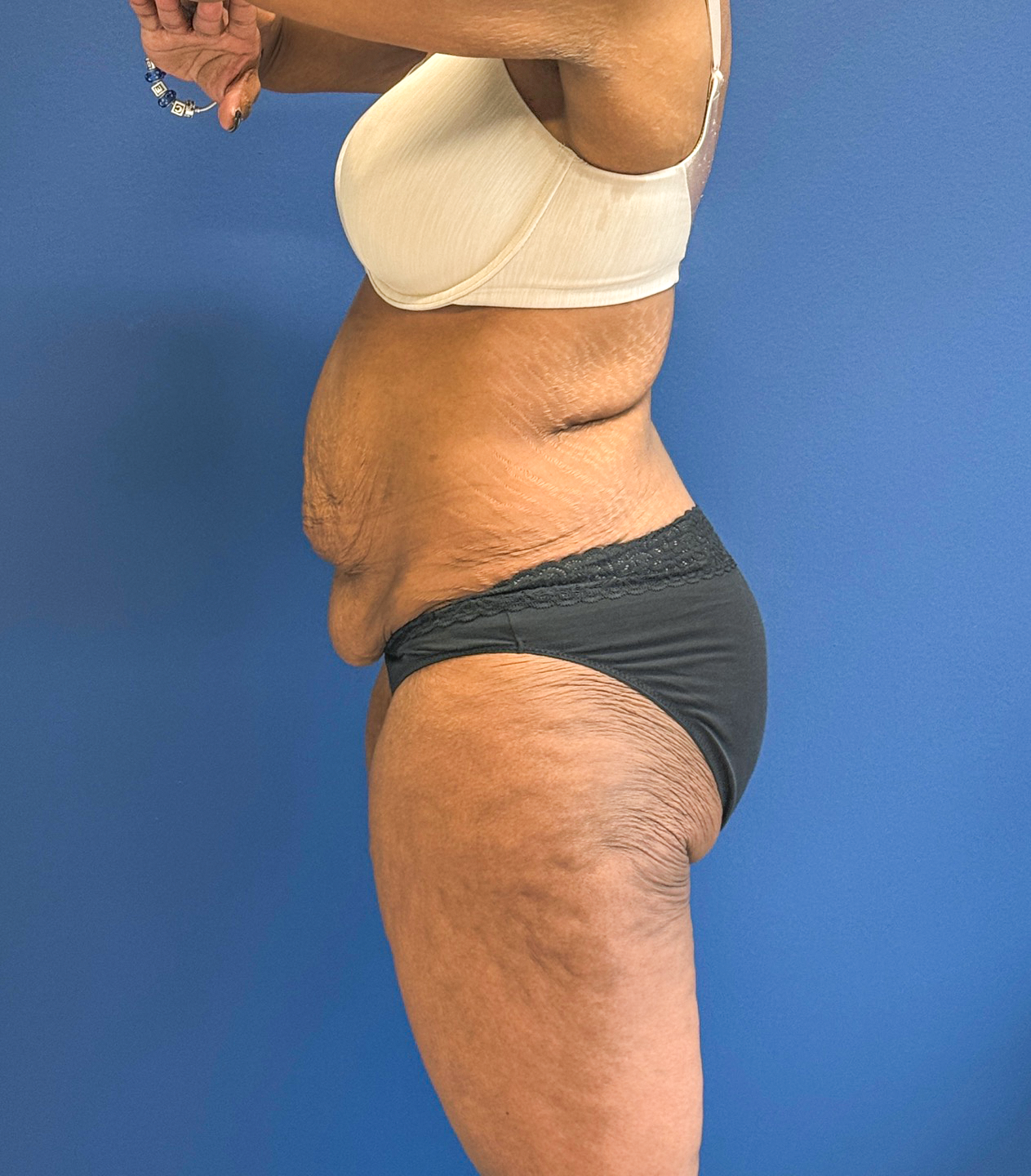 Tummy-Tuck-Case--28714 | Before Tummy Tuck 3
