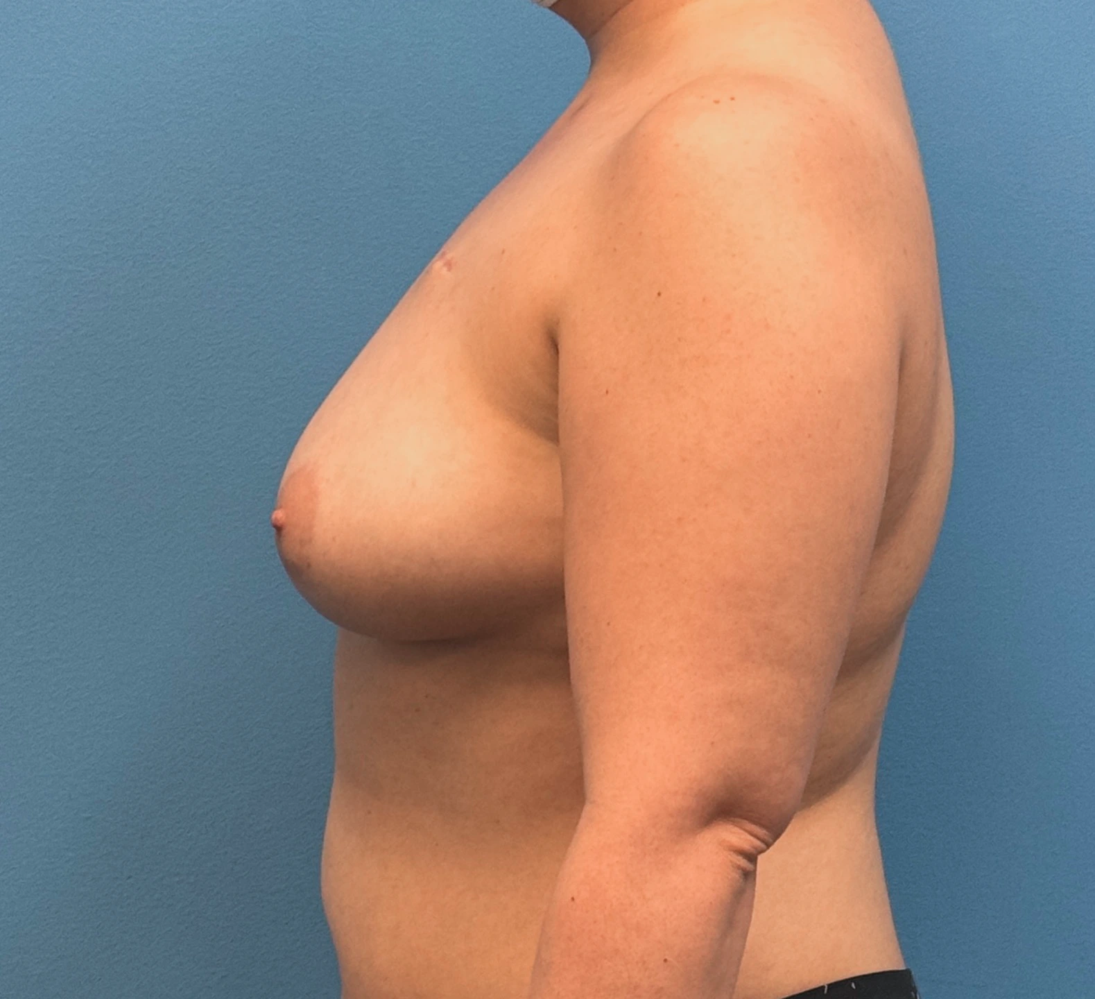 Breast-Reconstruction-Case--28689 | Before Breast Reconstruction 2