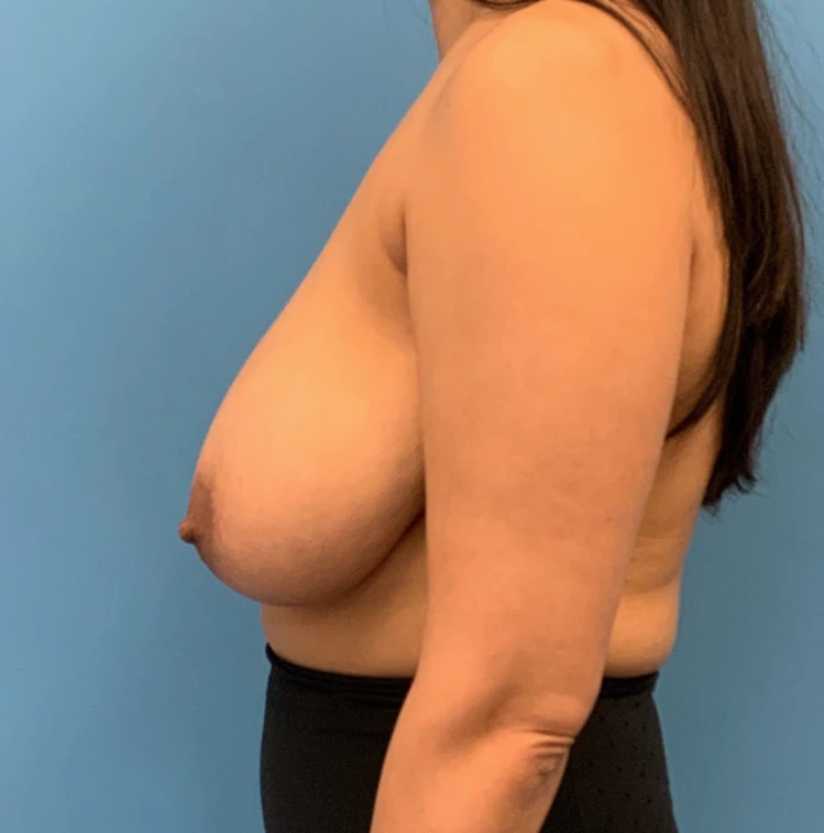 Breast-Reduction-Case--24290 | Before Breast Reduction 3