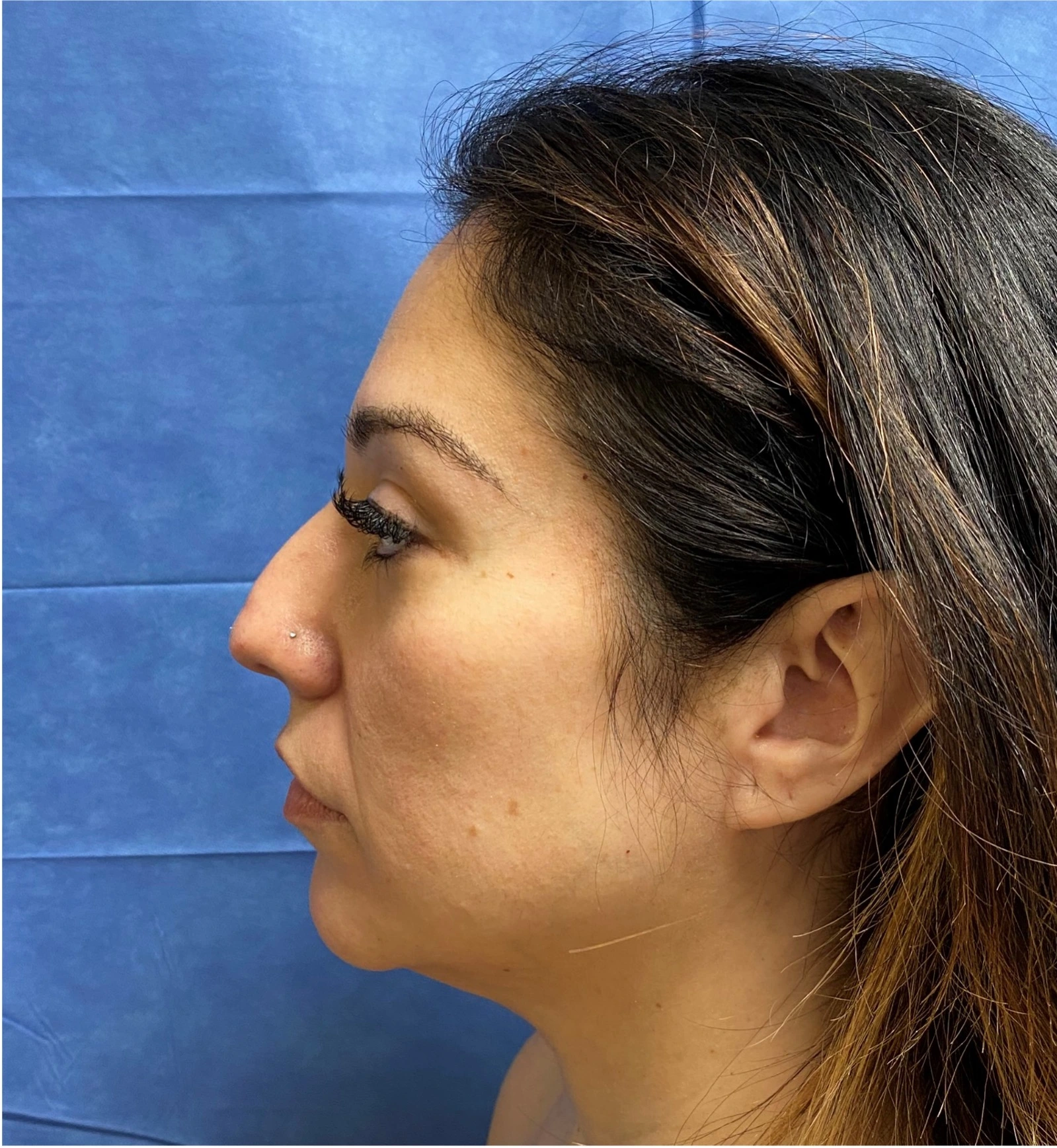 Rhinoplasty-Case--377 | Before Face 2