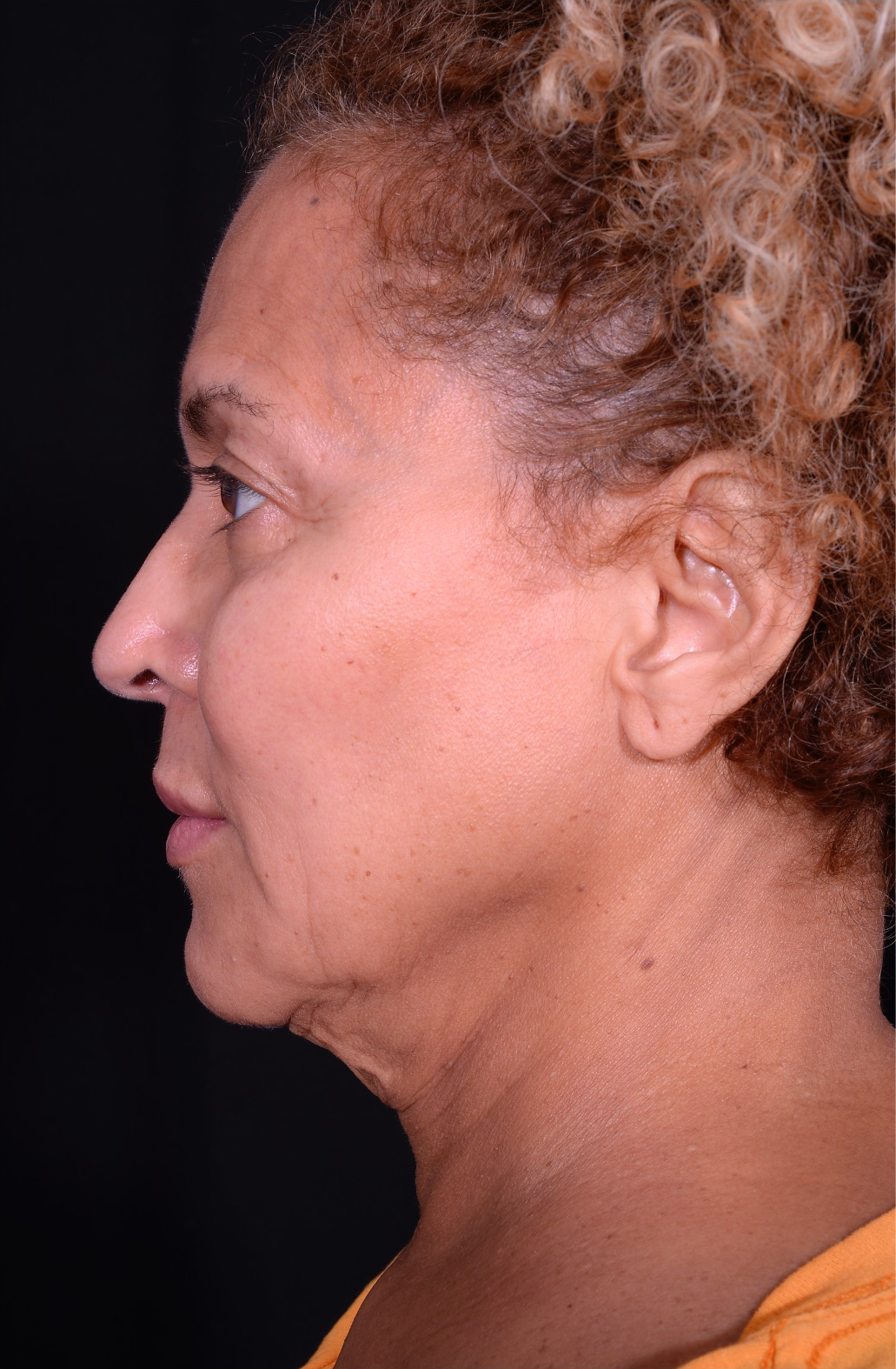 Facelift-Case--360 | Before Facelift 3