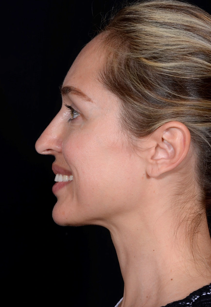 Rhinoplasty-Case--378 | Before Rhinoplasty 2