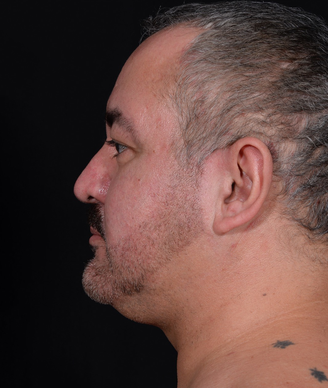 Liposuction-Case--368 | Before Face 2