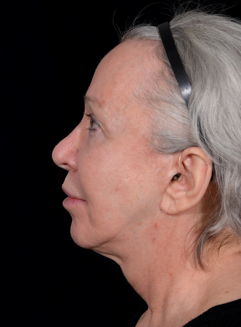 Facelift-Case--365 | Before Facelift 3