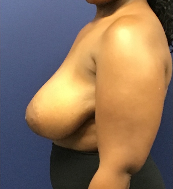 Breast-Reduction-Case--27530 | Before Breast Reduction 3
