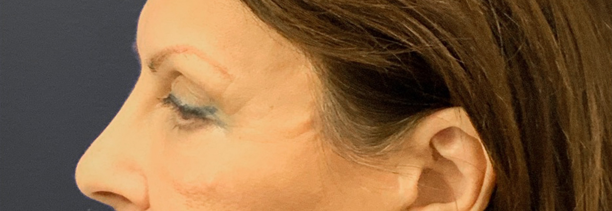 Blepharoplasty-Case--6272 | Before Dr. Arjun Kanuri 2