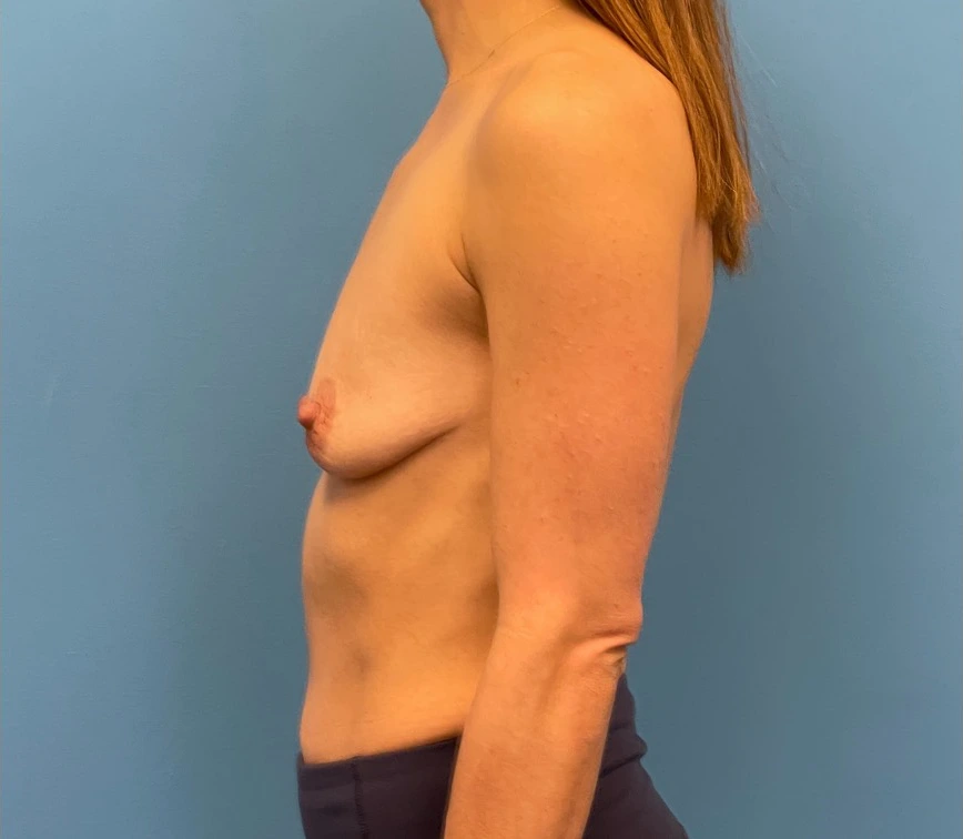 Breast-Augmentation-Mastopexy-Case--25025 | Before Dr. Samir Rao 2