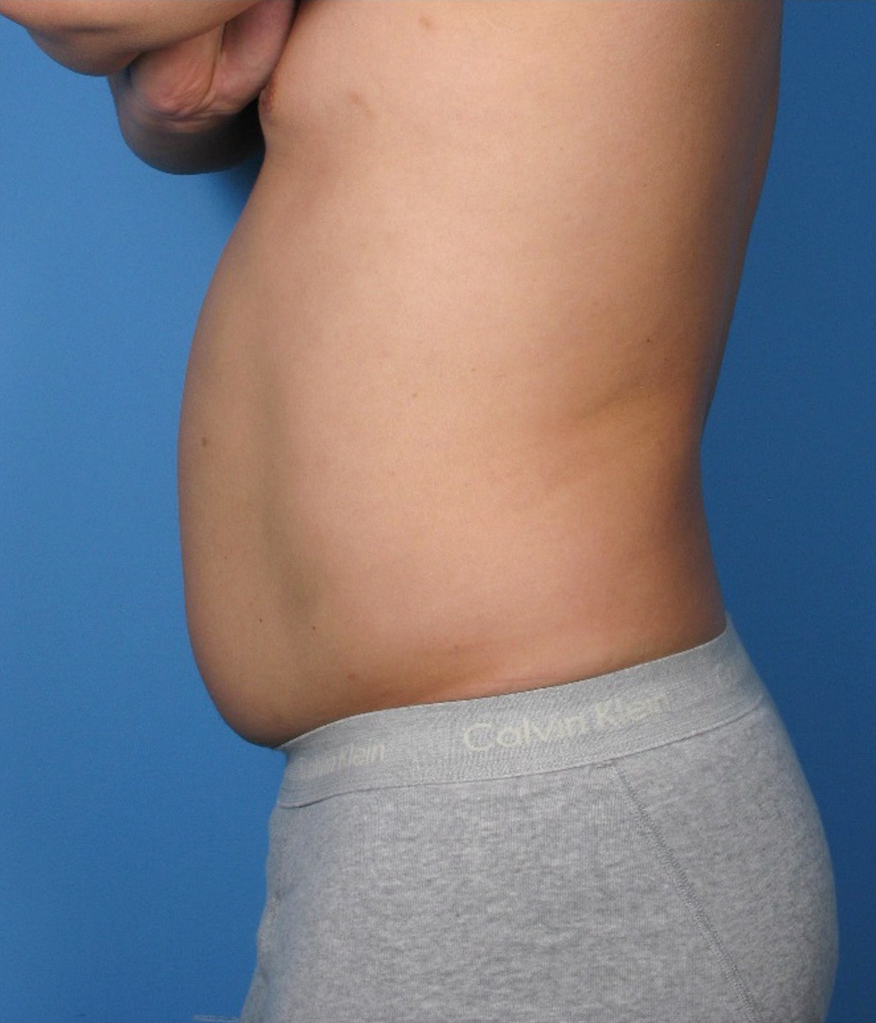 Case--389 | Before Liposuction 2