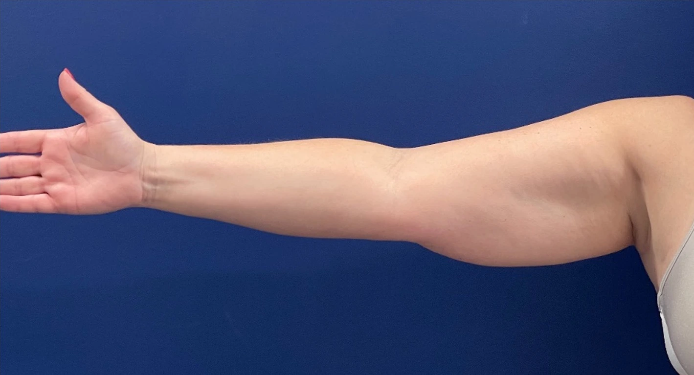 Case--399 | Before Liposuction 1