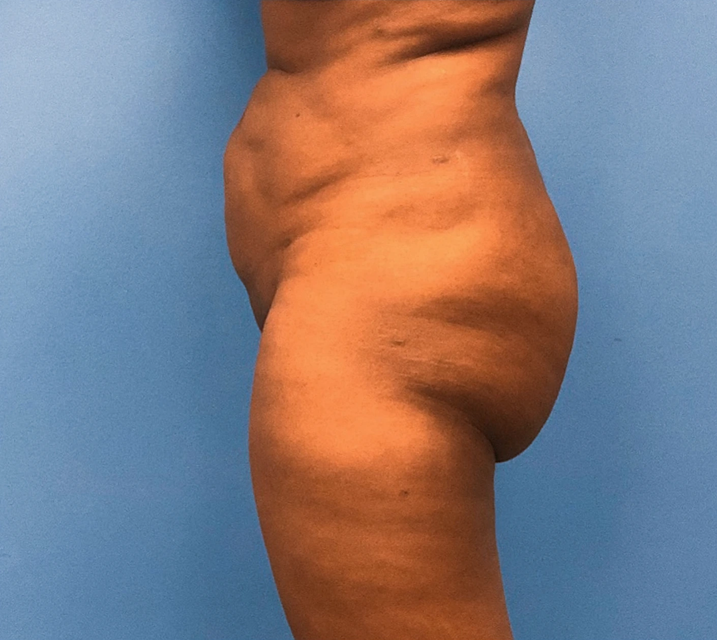 Brazilian-Butt-Lift-Case--267 | Before Dr. Samir Rao 2