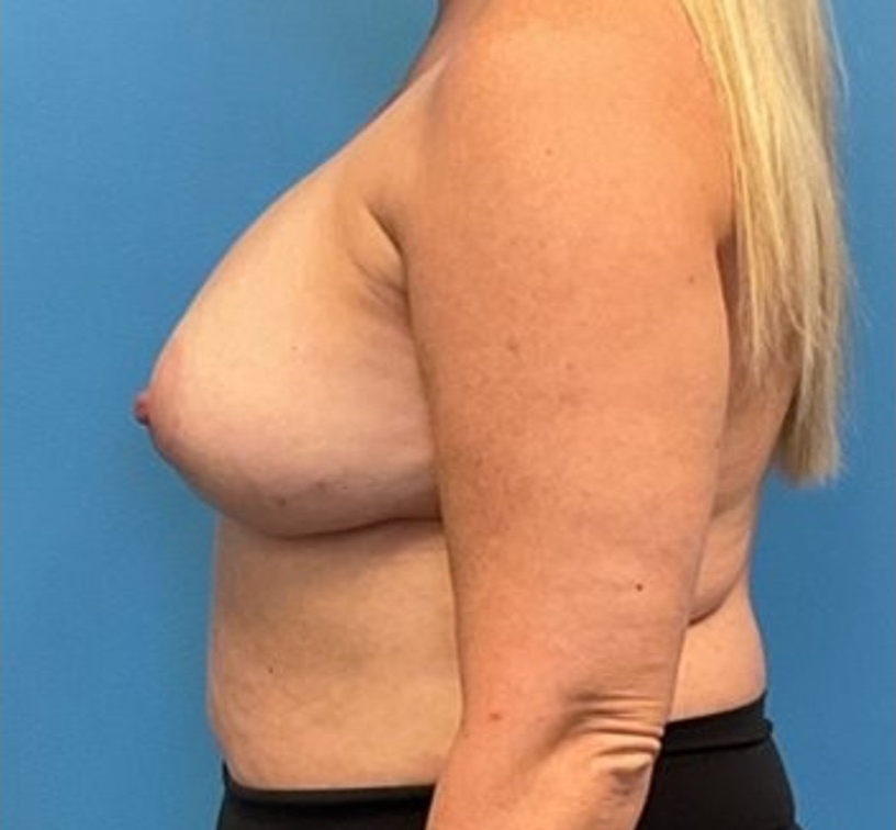 Breast-Reconstruction-Case--25682 | Before Breast Reconstruction 3