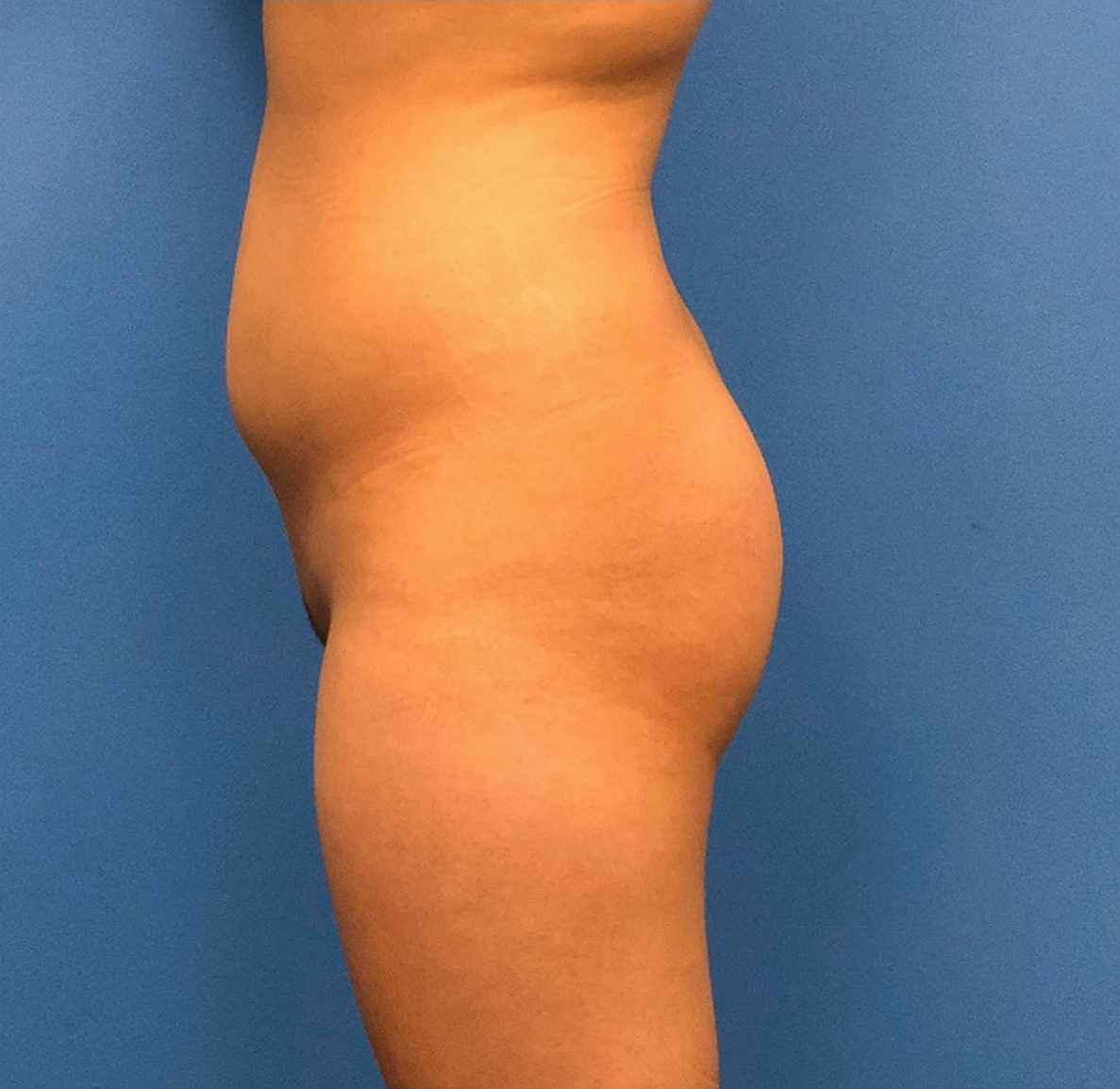 Brazilian-Butt-Lift-Case--268 | Before Brazilian Butt Lift 3
