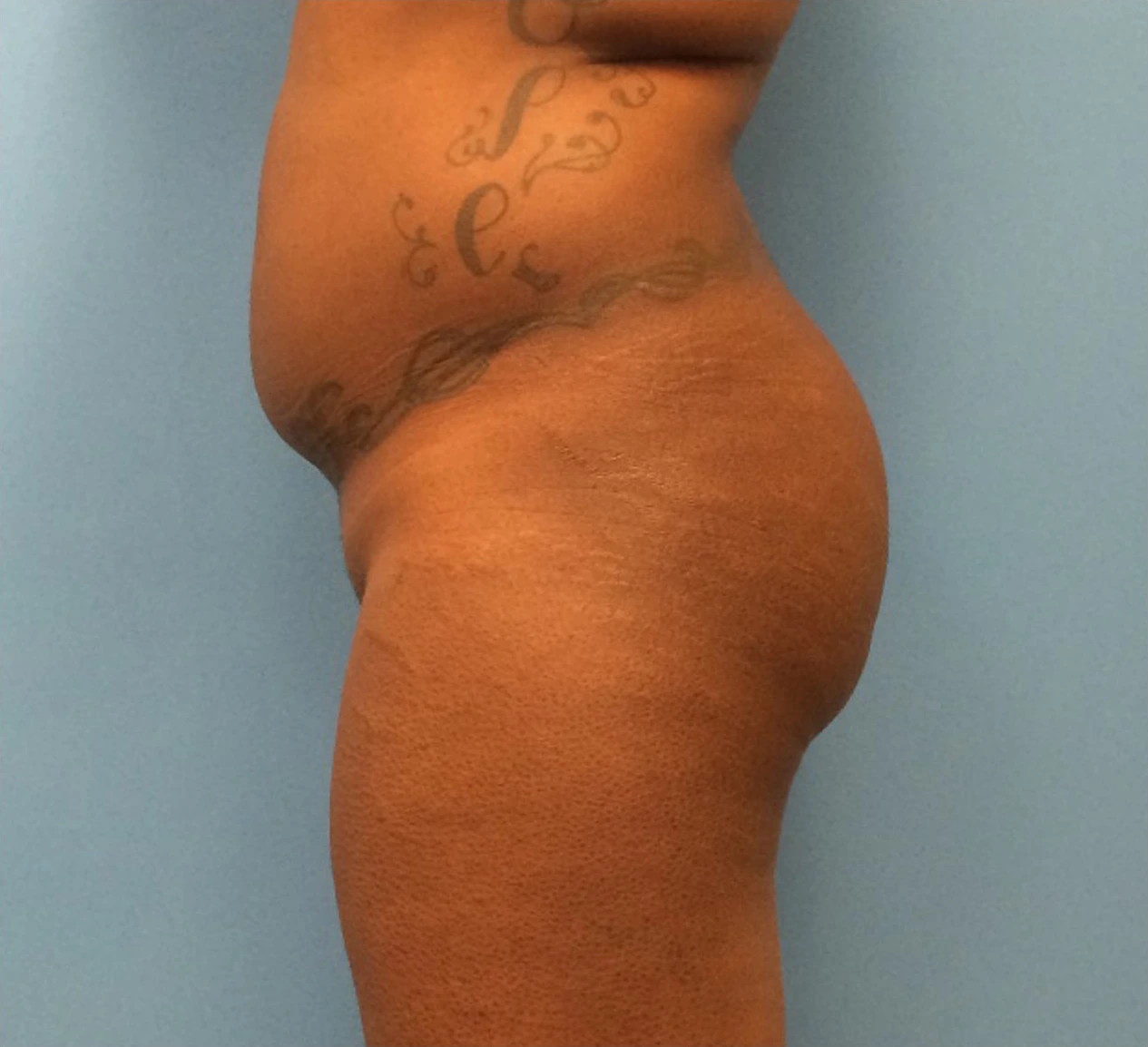Brazilian-Butt-Lift-Case--271 | Before Body 2