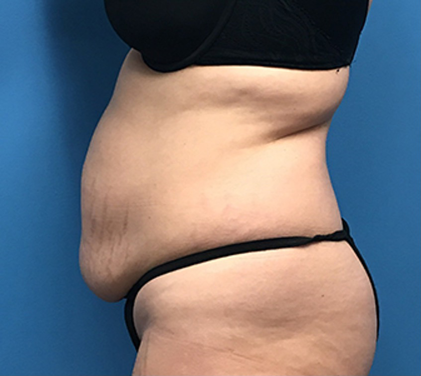 Case--56 | Before Body 2