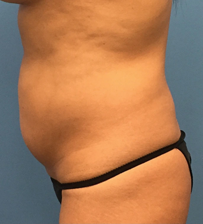 Case--65 | Before Body 2