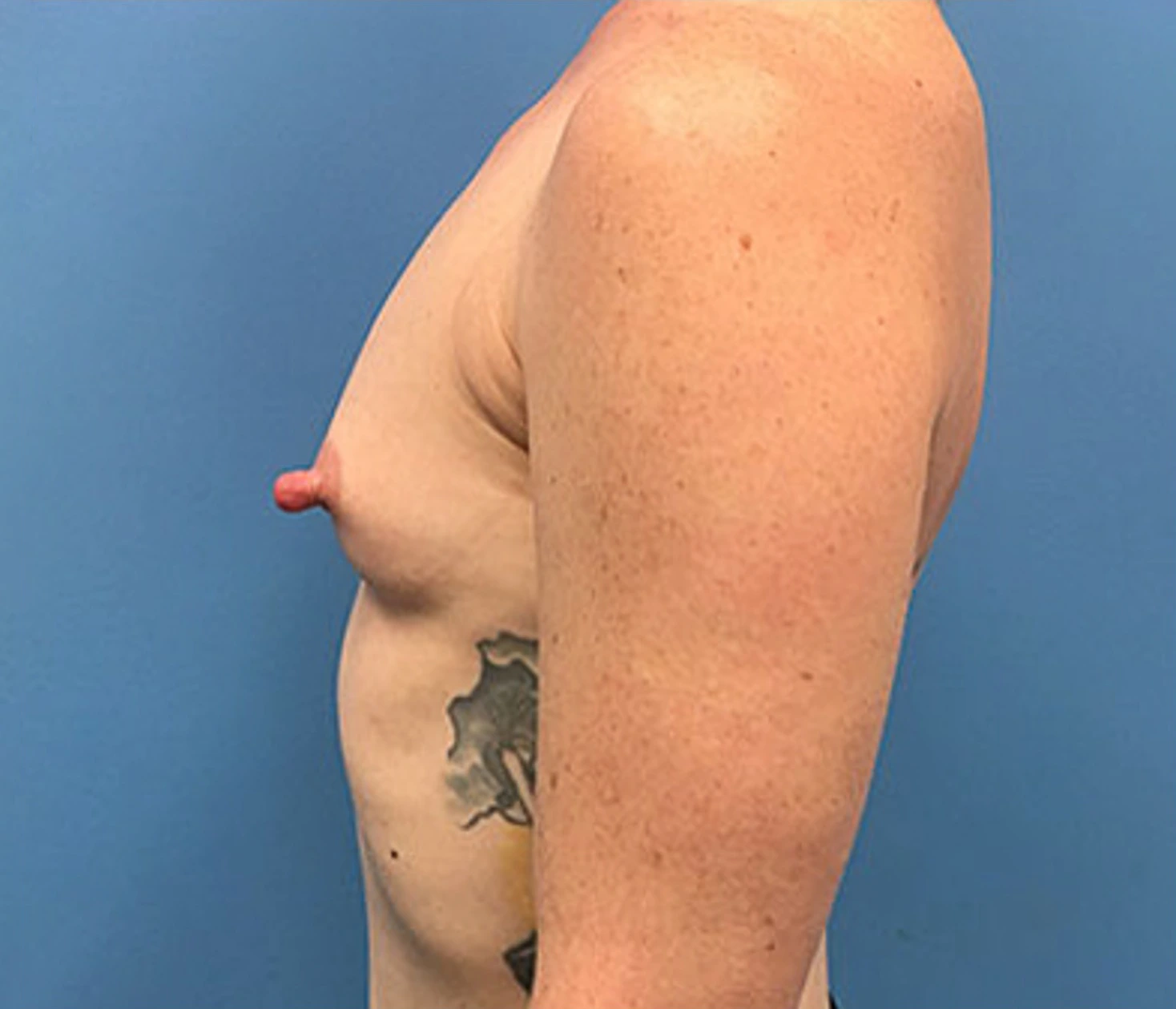 Case--88 | Before Breast Augmentation 4