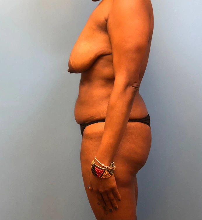 Mommy-Makeover-Case--13869 | Before Body 2