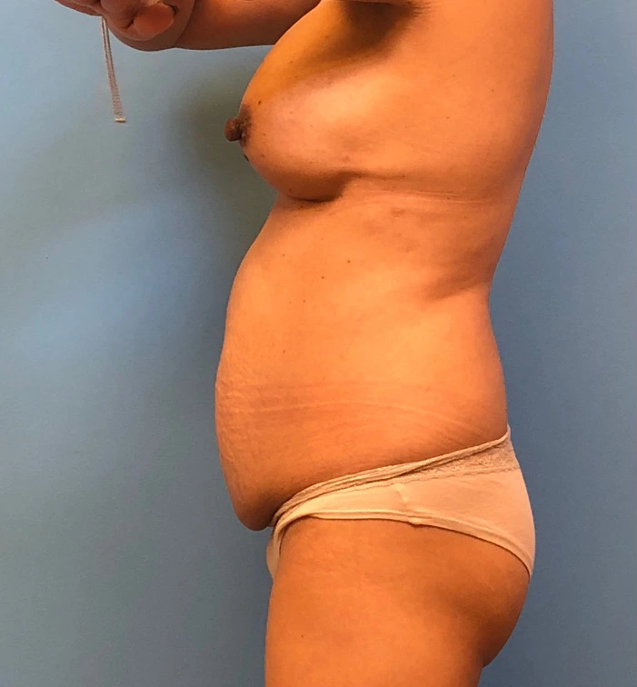 Case--11542 | Before Body 2