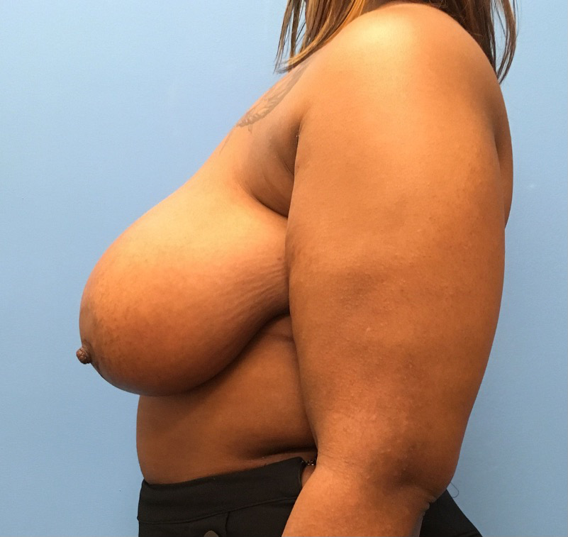 Breast-Reduction-Case--13002 | Before Breast Reduction 2