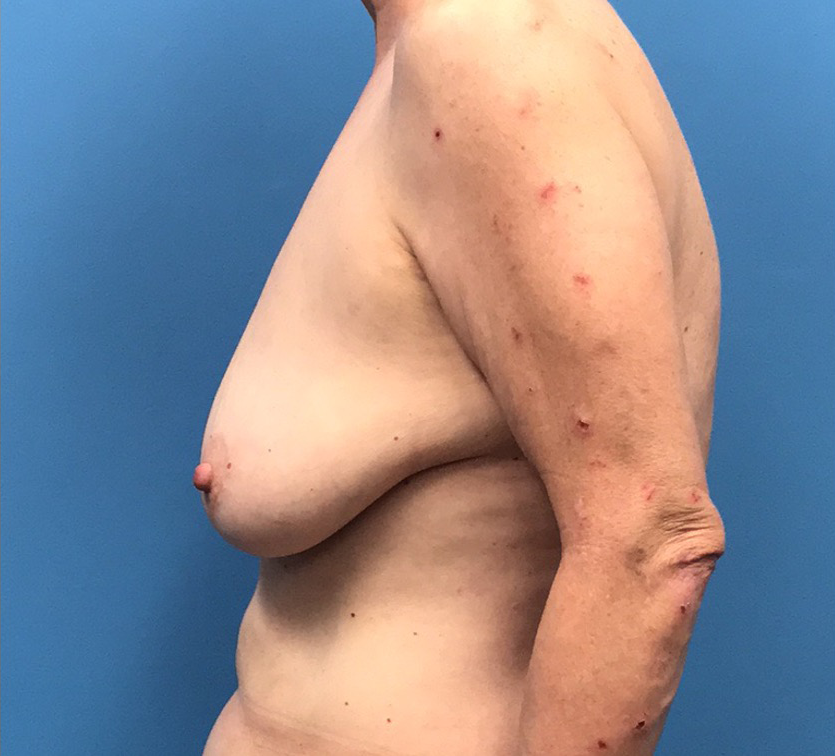 Case--10040 | Before Breast Reconstruction 2