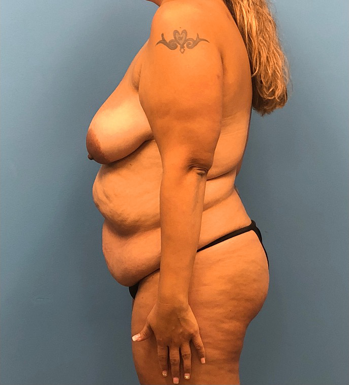 Lipoabdominoplasty-Breast-Augmentation-Case--15133 | Before Dr. Samir Rao 2