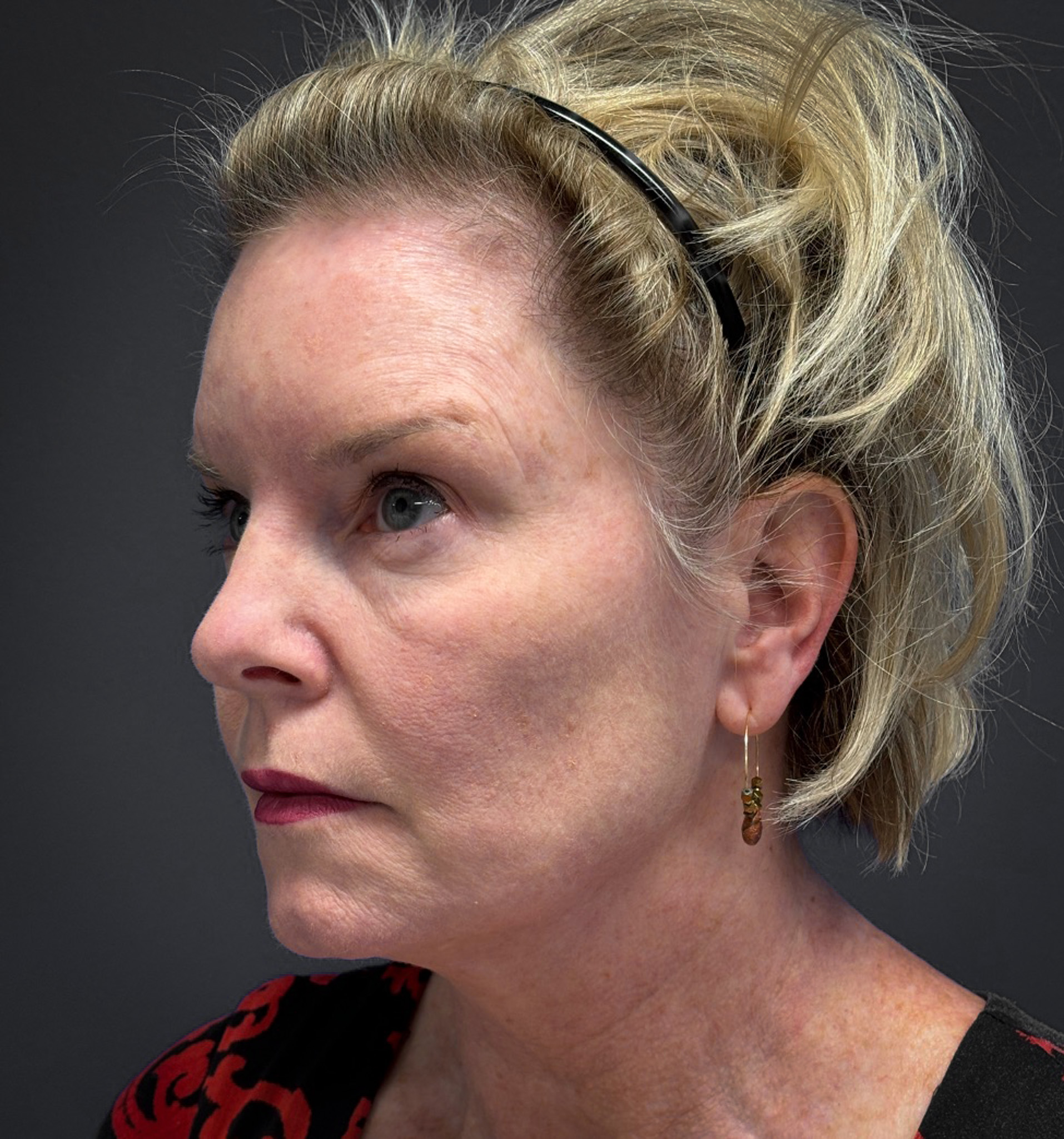 Blepharoplasty-Case--7015 | Before Eyelid Surgery 5