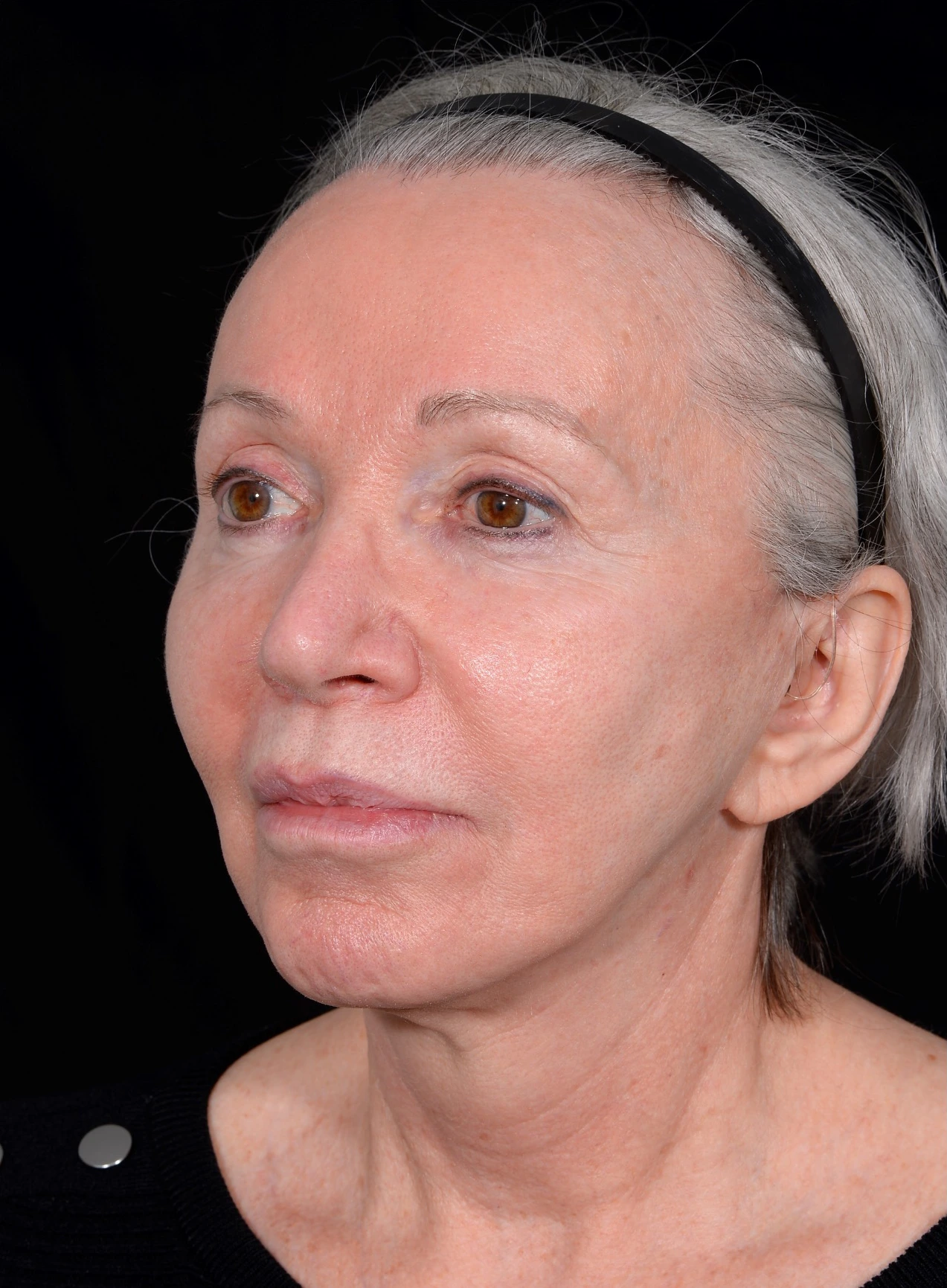 Facelift-Case--365 | Before Dr. Arjun Kanuri 2