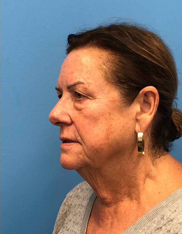 Facelift-Case--14406 | Before Dr. Samir Rao 2