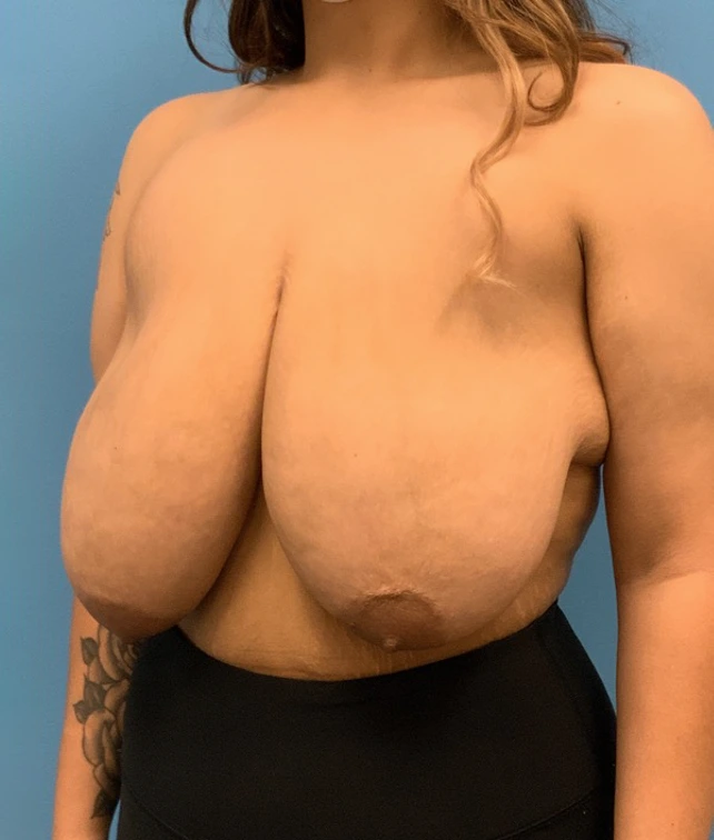 Breast-Reduction-Case--212 | Before Breast Reduction 2