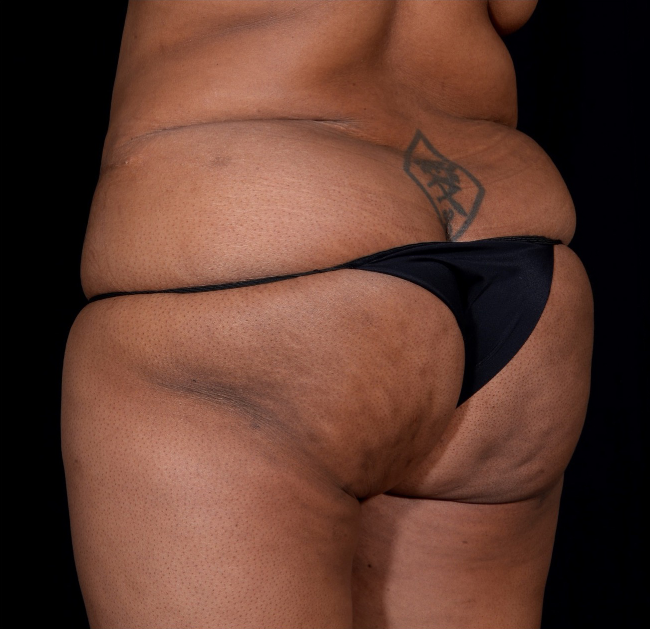 Brazilian-Butt-Lift-Case--352 | Before Dr. Arjun Kanuri 1