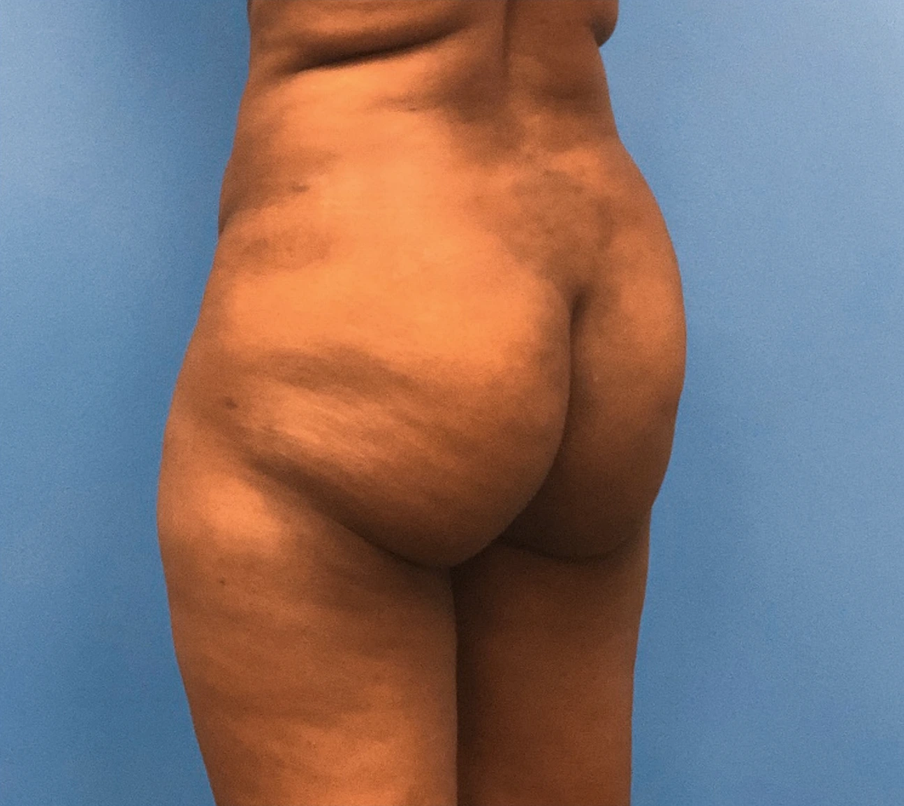 Brazilian-Butt-Lift-Case--267 | Before Dr. Samir Rao 1