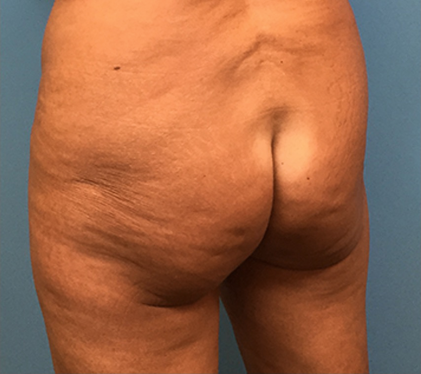 Brazilian-Butt-Lift-Case--74 | Before Brazilian Butt Lift 3