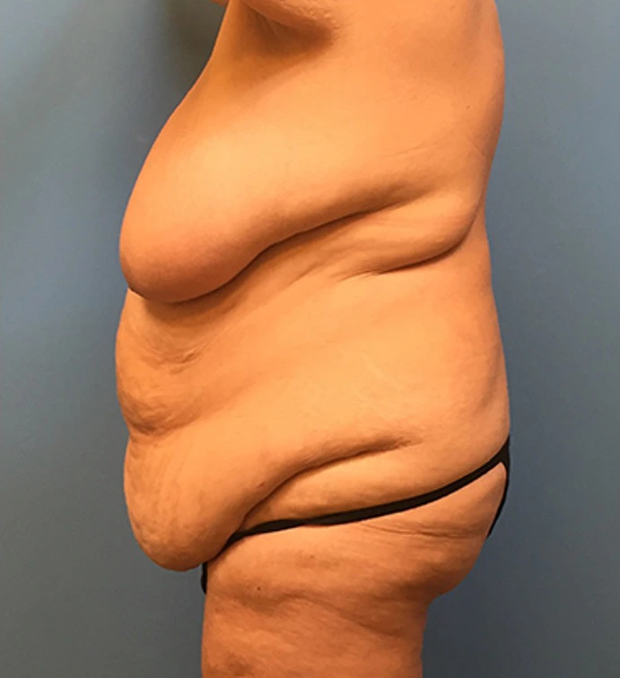 Mommy-Makeover-Case--39 | Before Body 2