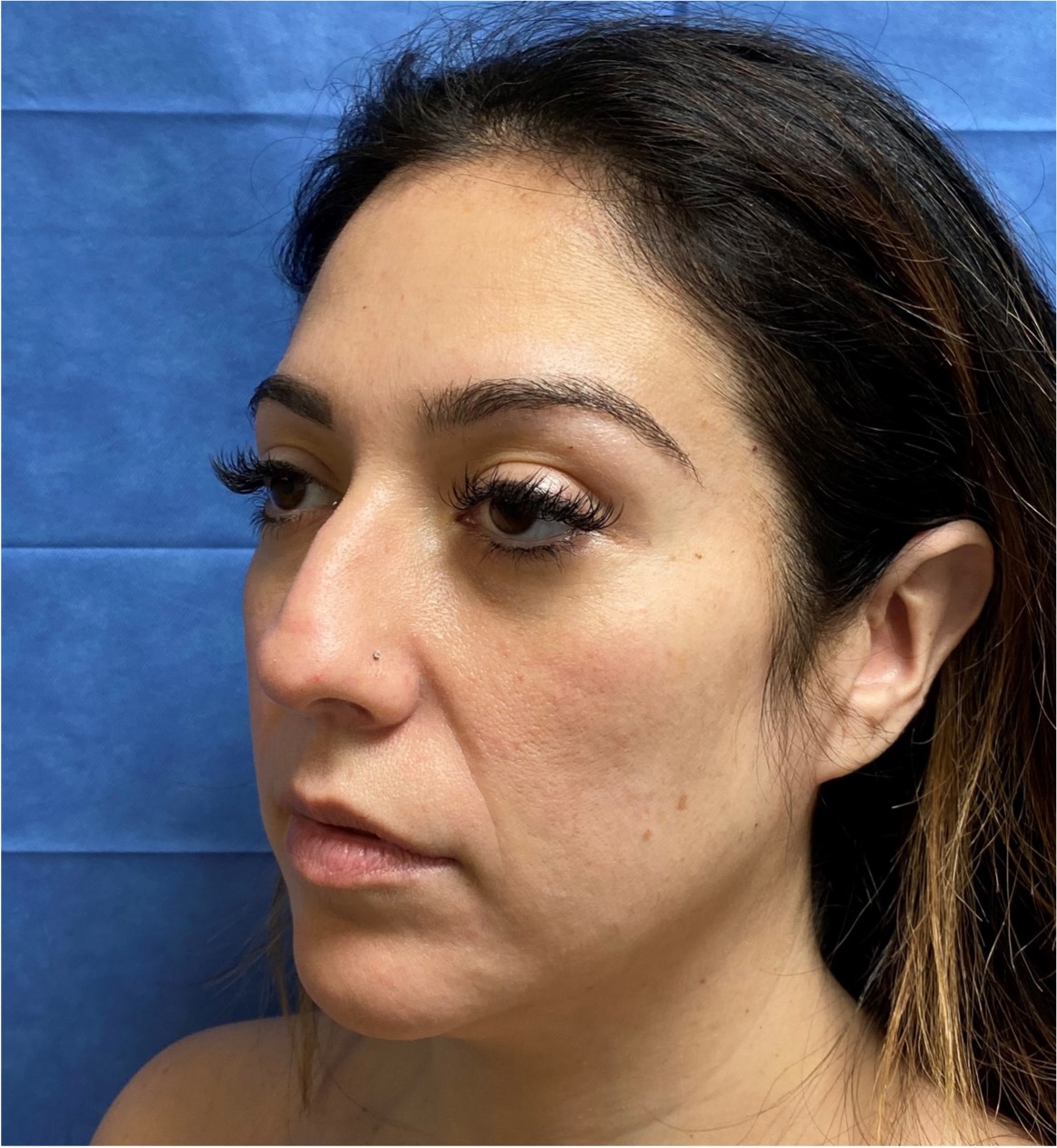 Rhinoplasty-Case--377 | Before Face 1