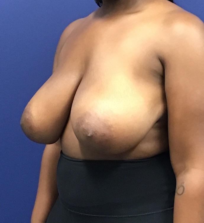 Breast-Reduction-Case--27530 | Before Breast Reduction 2