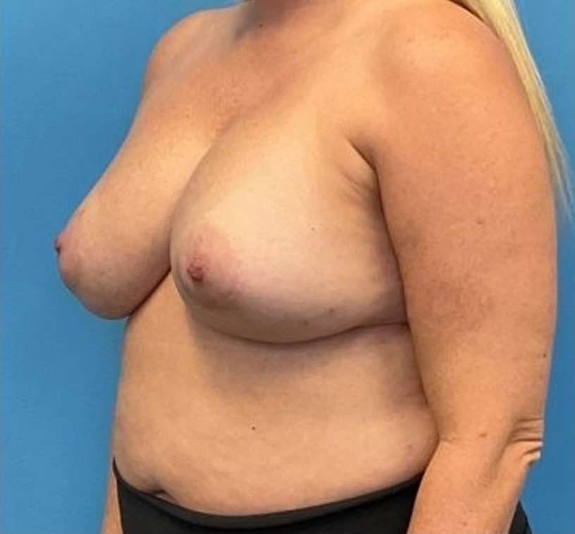 Breast-Reconstruction-Case--25682 | Before Breast Reconstruction 2
