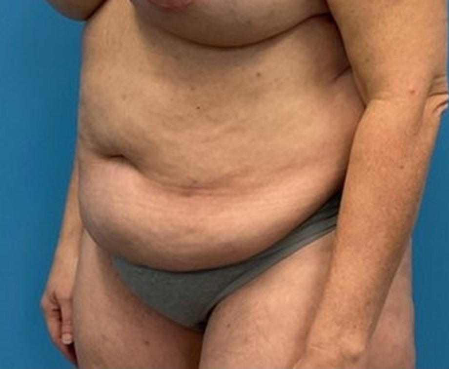 Liposuction-Tummy-Tuck-Case--25682-2 | Before Liposuction 2