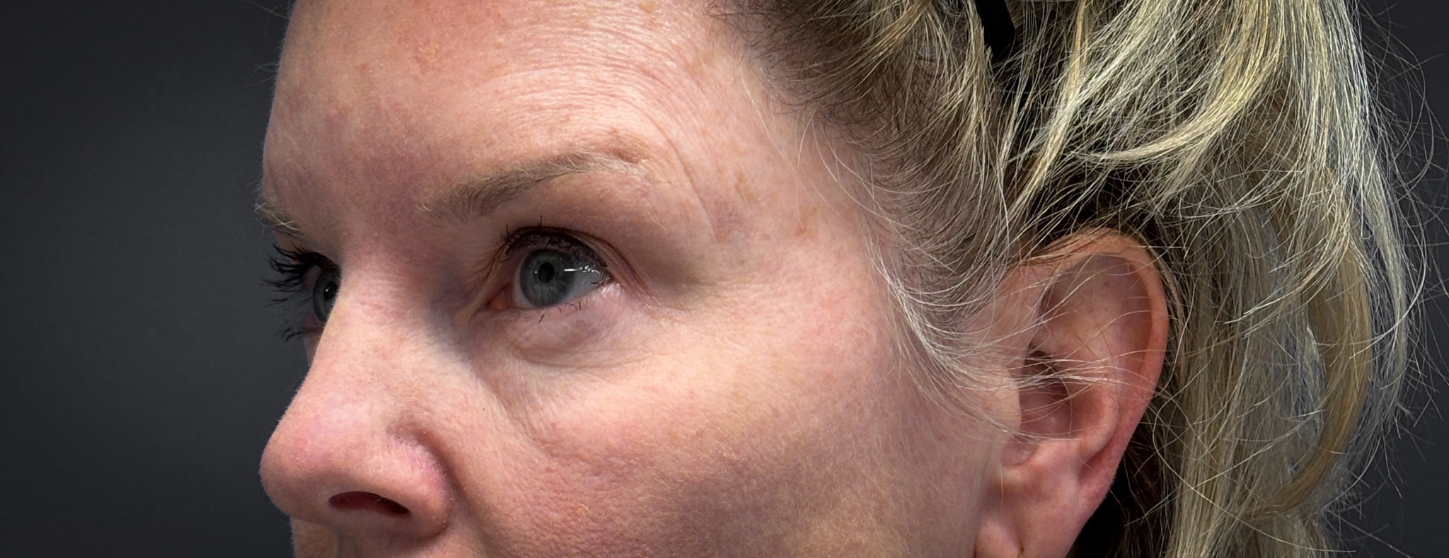 Blepharoplasty-Case--7015 | Before Dr. Arjun Kanuri 2