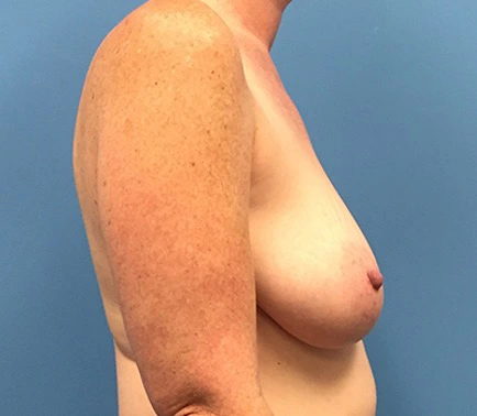 Case--137 | Before Breast Reconstruction 3