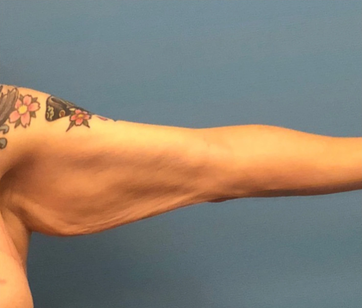 Brachioplasty-Arm-Lift-Case--18182 | Before Arm Lift 2