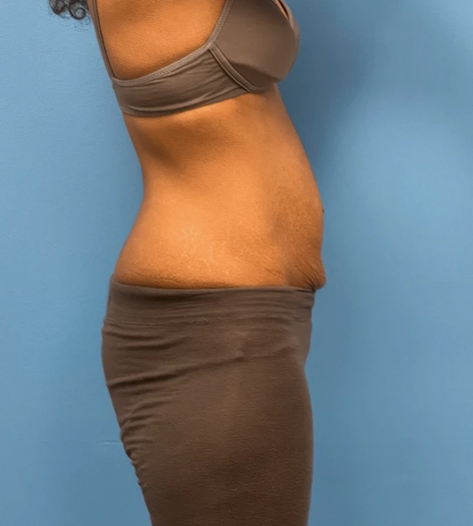 Abdominoplasty-Case--24922 | Before Liposuction 3