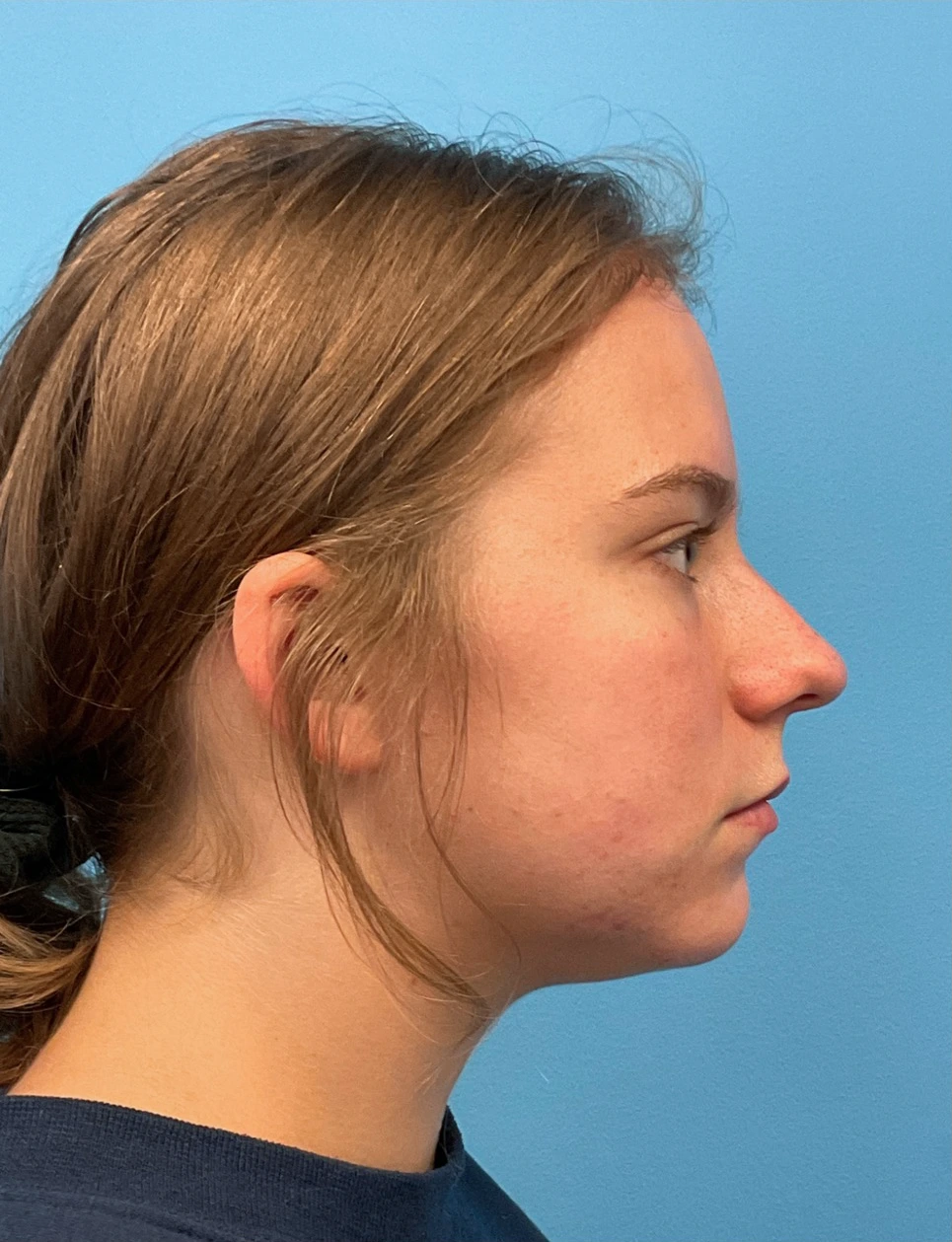 Rhinoplasty-Septoplasty-Case--23611 | Before Dr. Arjun Kanuri 2