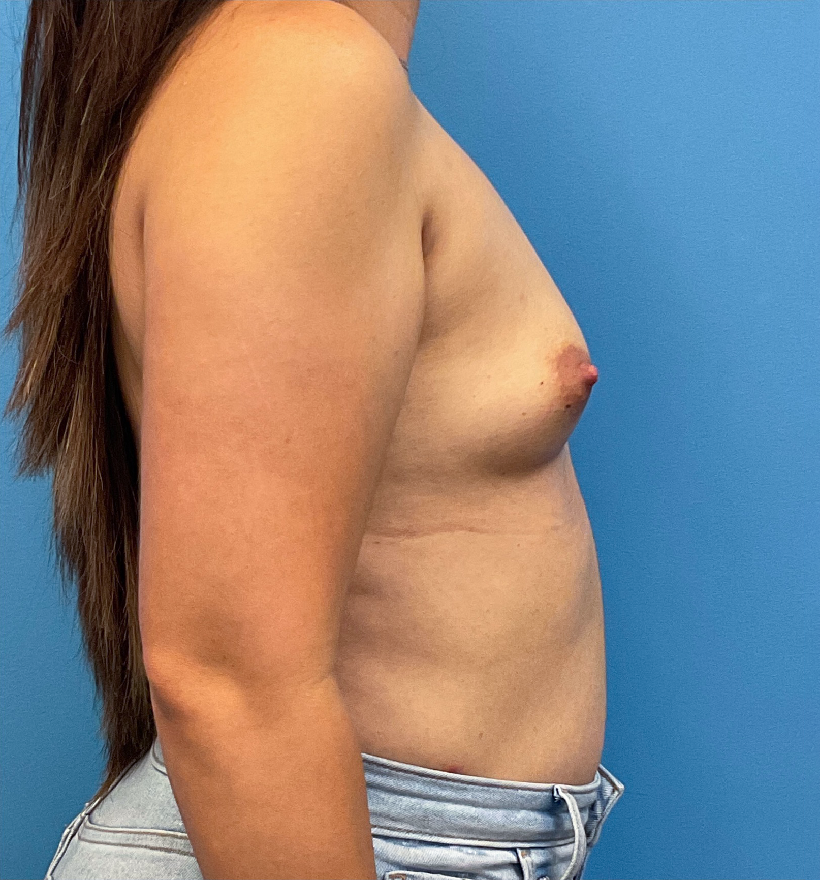 Breast-Augmentation-Case--25743 | Before Breast Augmentation 5