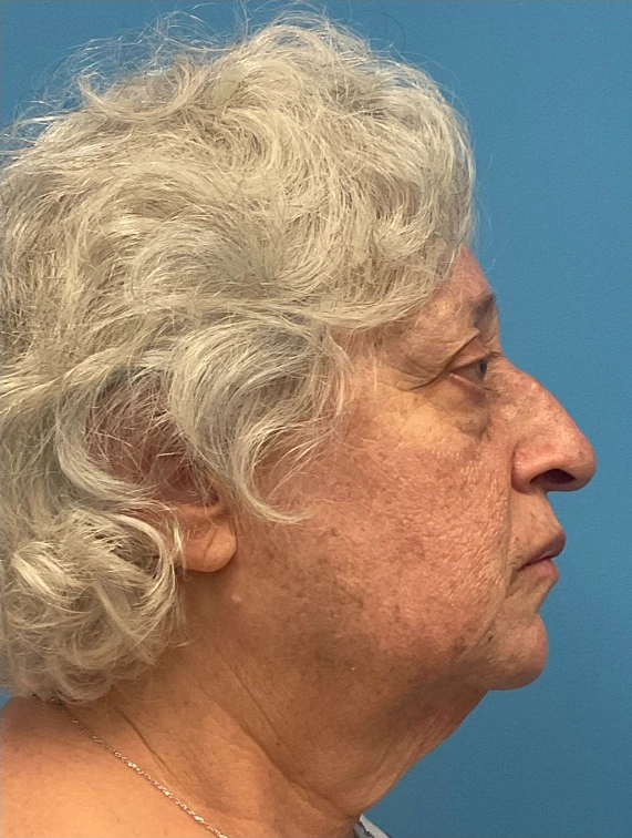 Rhinoplasty-Case--25467 | Before Face 2