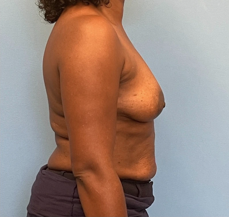 Breast-Reconstruction-Case--23930 | Before Breast Reconstruction 3