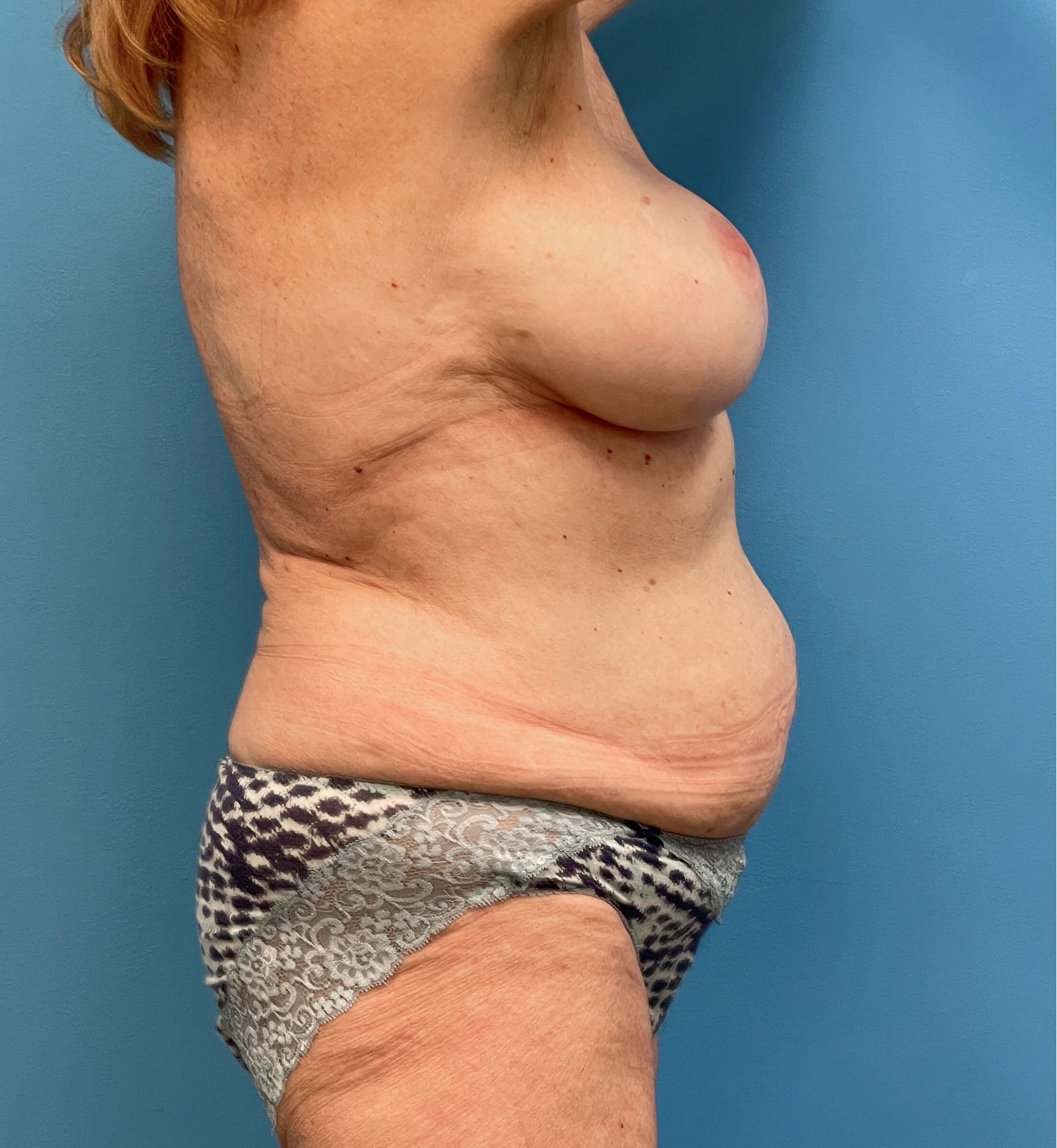Lipoabdominoplasty-Case--27935 | Before Liposuction 5