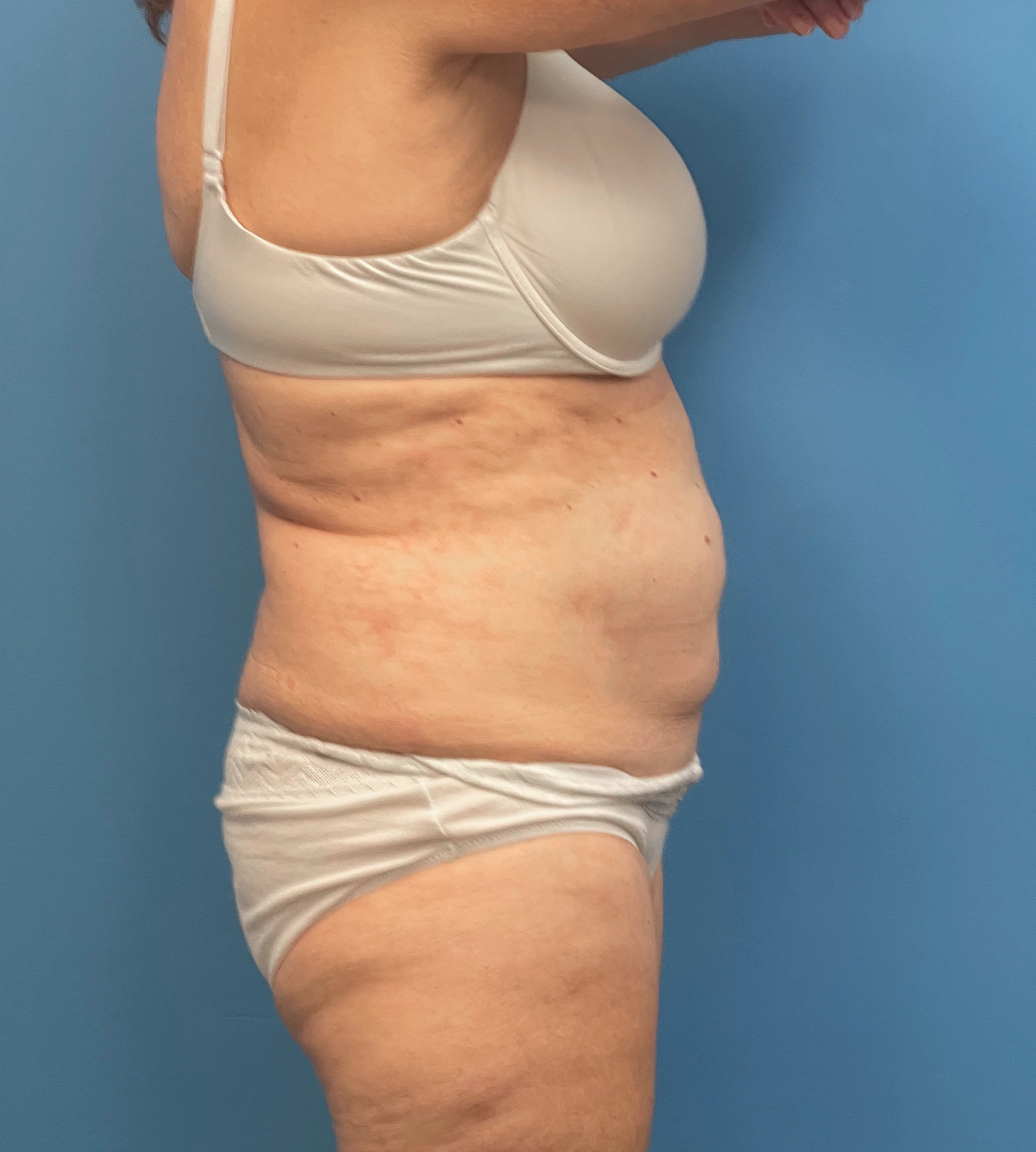 Abdominoplasty-Case--23690 | Before Liposuction 4