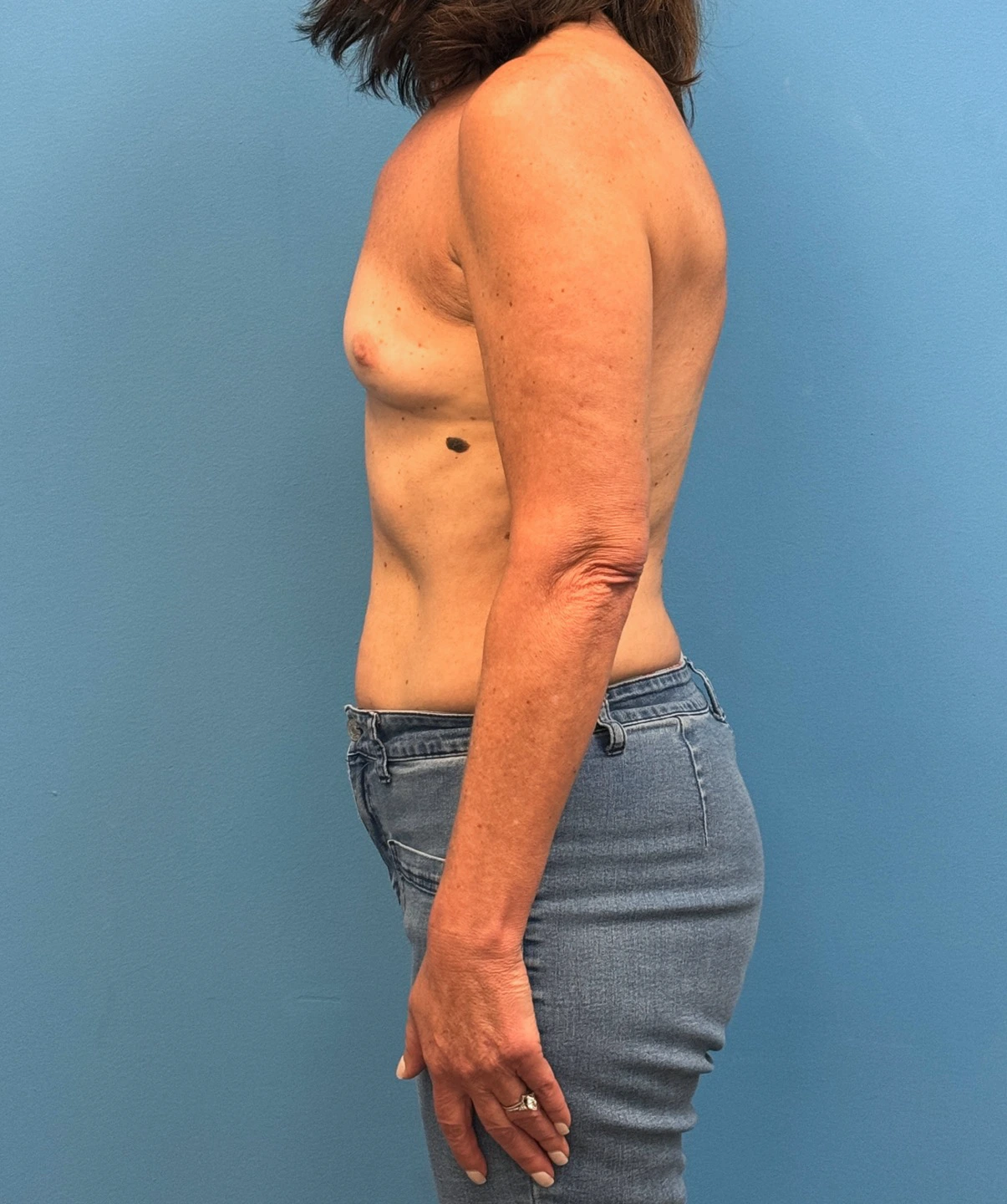 Breast-Reconstruction-Case--28688 | Before Breast Reconstruction 3